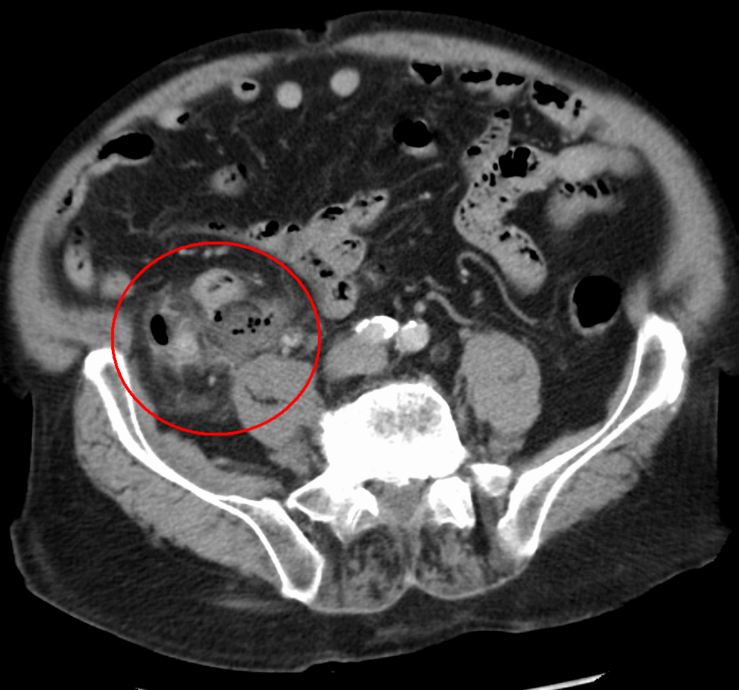 Understanding appendicitis and how EDAT can help