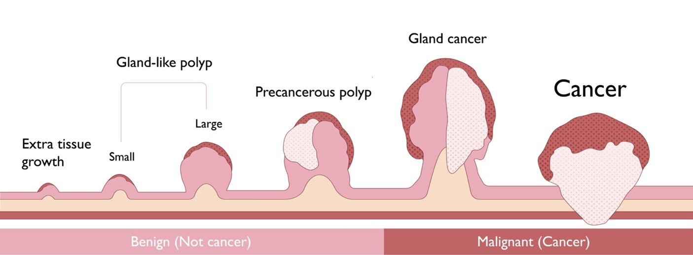 A Guide to Screening and Treatment for Early Gastrointestinal Cancers