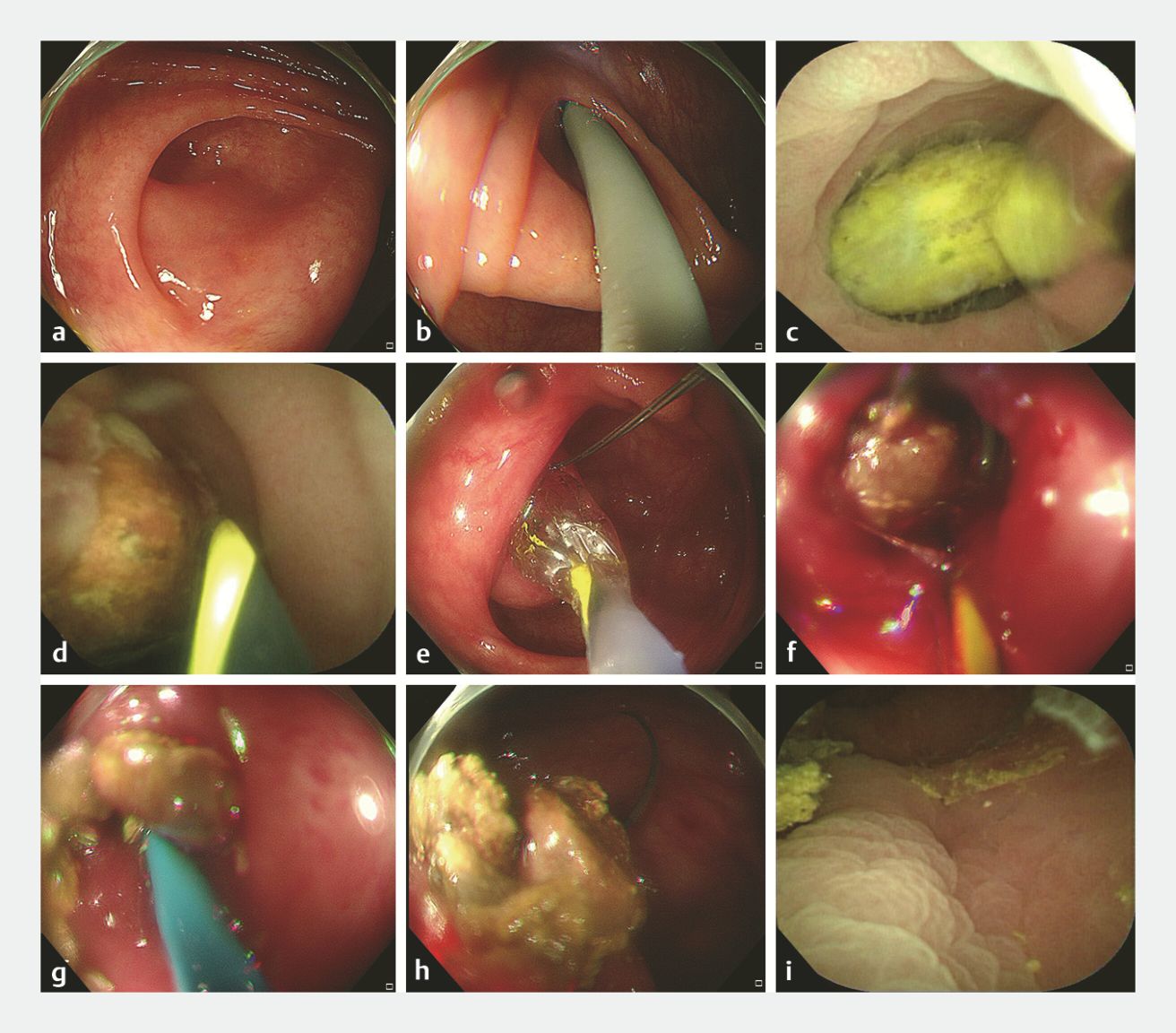 Internal view of gastrointestinal system with EDAT